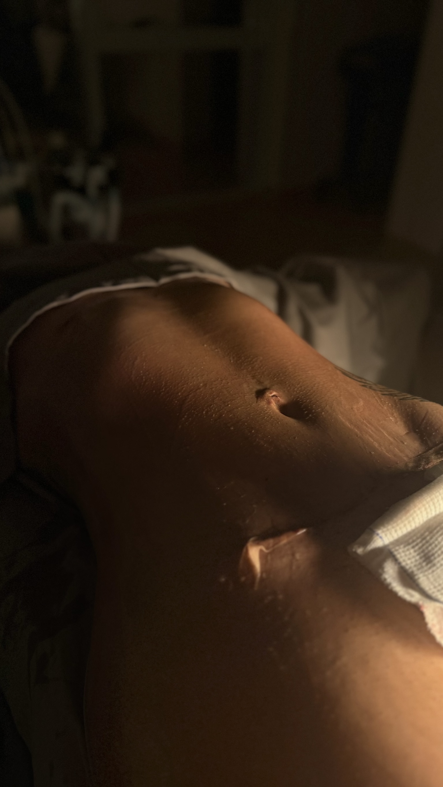 Abdominoplastia
